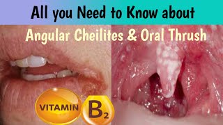 angular cheilitis  mounh ka pak jana  oral thrush  which vitamin u need in this condition [upl. by Soisinoid]