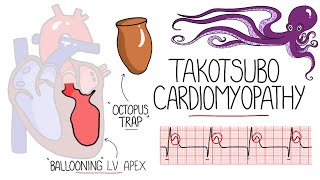 Takotsubo Cardiomyopathy Explained Broken Heart Syndrome [upl. by Tesler132]