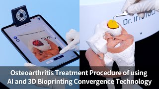 Cartilage Regeneration Osteoarthritis Treatment Procedure of using AI and 3D Bioprinting [upl. by Nolana]