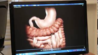 Gastrik Bypass Ameliyatı Nedir ProfDr Oktay Banlı [upl. by Ahsinehs]