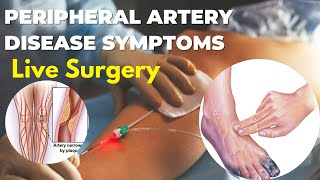 Peripheral Artery Disease In Legs  peripheral Balloon Angioplasty And Stenting [upl. by Laemsi65]