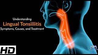 Lingual Tonsillitis A Comprehensive Guide [upl. by Nuawed]