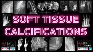 SOFT TISSUE CALCIFICATIONS [upl. by Adele]