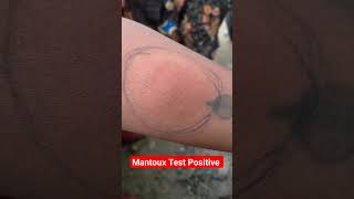 Mantoux Test Result Positive shortsyoutubeshorts virulshorts [upl. by Emanuela618]