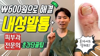 리얼한 내성 발톱 케어방법  Ingrown Toenail treatment [upl. by Nnylyar]