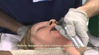 Intubation Extubation 37 [upl. by Otreblig]