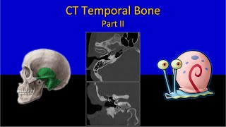 CT Temporal Bone Made Easy Part 2  Step by Step Approach [upl. by Tenenbaum]