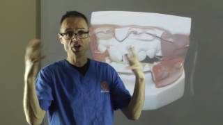 Effect of Frankel Regulator on Teeth Alignment amp Bone During Orthodontic Treatment by Dr Mike Mew [upl. by Darom136]