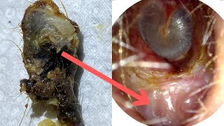 150  Huge Ear Wax Plug Extracted from Ear Crater due to Benign Osteonecrosis using WAXscope®️ [upl. by Euqininod]