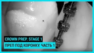 Crown prep Stage 1 Преп под коронку Часть 1 [upl. by Clabo]