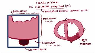 Heart attack acute myocardial infarction causes symptoms diagnosis treatment pathology [upl. by Calica]