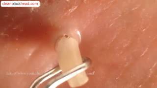 Blackhead Removal Tool  Popping Whiteheads and Blackheads Close Up [upl. by Aicined]