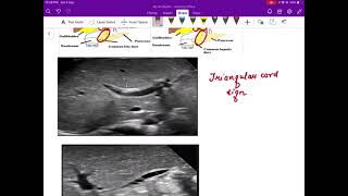 Biliary atresia radiology [upl. by Elletse]