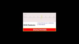 Diagnosis And ECG features Of Wolf Parkinson White  WPW  Syndrome [upl. by Atsyrk585]