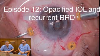 Retina Chats Episode 12 Opacified IOL and recurrent retinal detachment [upl. by Leia]