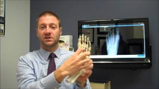 Lisfranc Injuries [upl. by Htiek]