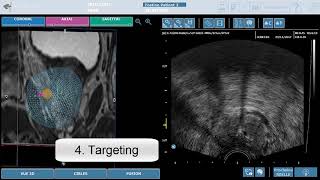 FTI2018 3Dimageguided transrectal focal microwave treatment  First in human [upl. by Christophe532]