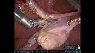 Easy Case Robotic  Reduced port jain technique [upl. by Akinhoj]