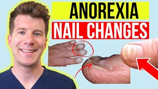 6 finger nail changes seen in ANOREXIA  Doctor explains [upl. by Dimond21]