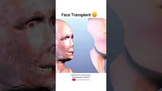 Face Transplant surgery 🎭 [upl. by Farley]