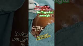 Successful radio frequency ablation for trigeminal neuralgia at jaipur [upl. by Ayotal]