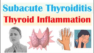 Subacute Thyroiditis Thyroid Inflammation De Quervain’s  Causes Symptoms Diagnosis Treatment [upl. by Alberto]