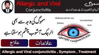 Smog Effect On Eyes  Allergic and Viral Conjunctivitis  Symptom Treatment Nafamine DrAHMandal [upl. by Akcirderf]