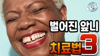 벌어진 앞니 사이 공간 치료법 3가지 Diastema Closure [upl. by Naesyar]