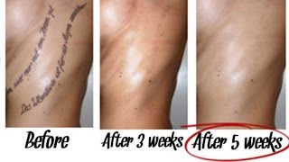 Best Way to Remove Tattoos Naturally within 5 Weeks [upl. by Grath]