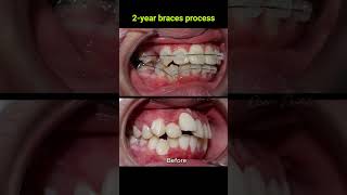 Braces evolution  2 years braces orthodontist dentist [upl. by Yessej]