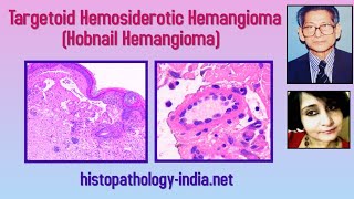 Pathology of Targetoid Hemosiderotic Hemangioma Hobnail Hemangioma  Dr Sampurna Roy MD [upl. by Charmane991]