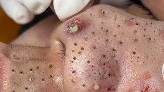 Big Cystic Acne Blackheads Extraction Blackheads amp Milia Whiteheads Removal Pimple Popping  5083 [upl. by Fortna]