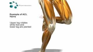 ACL Tear Sports Injury [upl. by Ramej384]