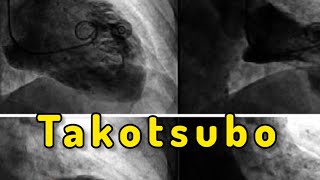 Takotsubo Cardiomyopathy “Broken Heart Syndrome” [upl. by Anneres]