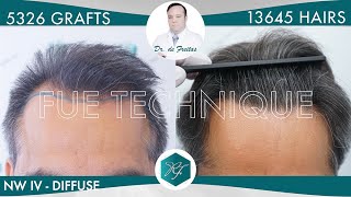 Hair Graft Technique FUE  5326 Grafts 13645 Hairs [upl. by Alig851]