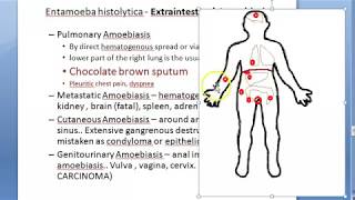 Parasitology 026 e Extraintestinal Amoebiasis entamoeba histolytica hepatic liver abscess anchovy [upl. by Alegnaoj]