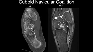 Cuboid and Navicular Coalition [upl. by Hutson299]