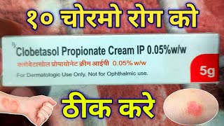 Clobetasol Cream use For एग्जिमा एलर्जी Damataitisskin rashes  soriasis  Review in hindi [upl. by Nivag62]