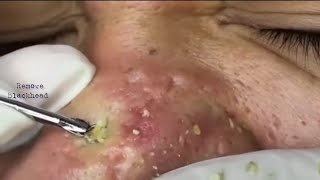 Acne Treatment Blackhead Removal on his nose Remove Blackhead removeblackhead [upl. by Leummas940]