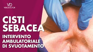 CISTI SEBACEA intervento ambulatoriale di svuotamento [upl. by Semadar45]