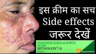 The Shoking Truth Of Betnovate N Cream Betnovate n cream Review and Side effects [upl. by Gaige]