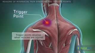 Myofascial pain syndrome and trigger points Reasons [upl. by Kurtis]