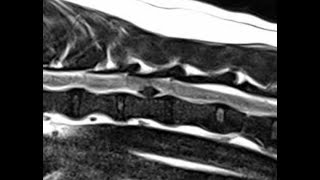 MRI of intraduralextramedullary intervertebral disc extrusion in dogs [upl. by Ddet]