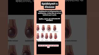 Infaction epididymis रोग treament एंटीबायोटिक एंटीवायरल रखरखाव अच्छी स्वच्छता यूरिन ट्रैक केय [upl. by Aeneas229]