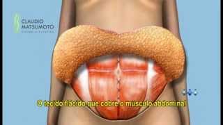 ABDOMINOSPLASTIA Simulação 3D  Dr Claudio Matsumoto  Cirurgia Plástica [upl. by Alyda189]