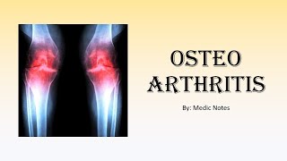 Ortho Osteoarthritis  risk factors causes signs amp symptoms xray findings treatment [upl. by Maffei]