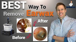 The BEST Way to Professionally Remove Earwax  Earigator Cerumen Irrigation [upl. by Urana]