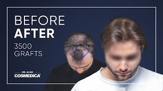 Hair Transplant in Turkey  Hair Transplant Results of Cosmedica [upl. by Ehsrop]