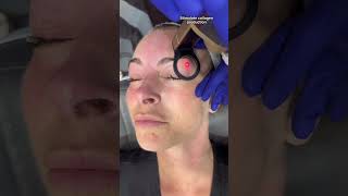 CO2 Laser Resurfacing Around The Eyes  Dr Medispa [upl. by Walcoff]