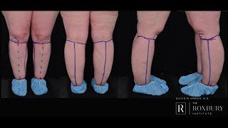 Lipedema Evaluation Diagnosis and Treatment Plan [upl. by Shelba]